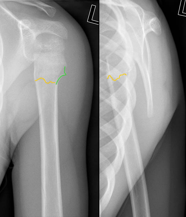 Fraktur des proximalen Humerus